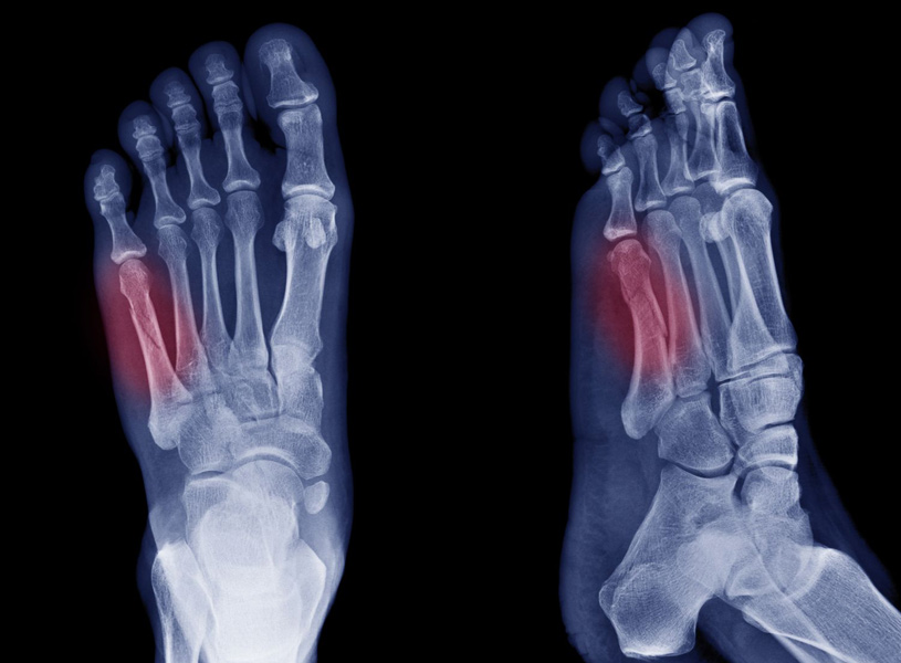 5th-metatarsal