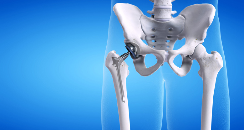 Hip Arthroplasty