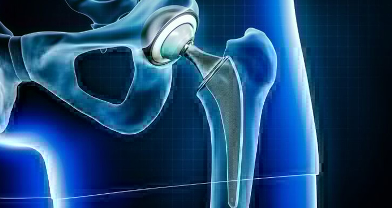 Hip Arthroplasty