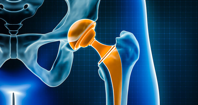 Hip Arthroplasty