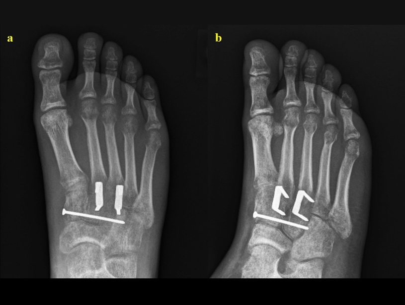 LISFRANC-(MIDFOOT)