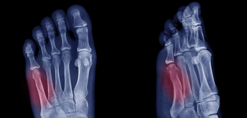METATARSAL