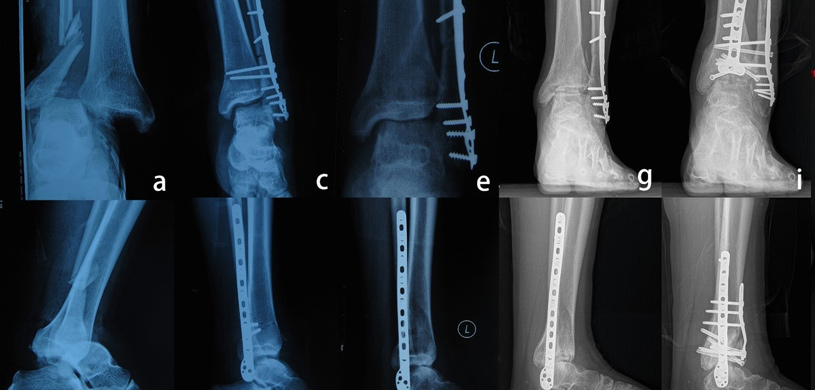 TIBIAL-PLAFOND-DISTAL-TIBIA