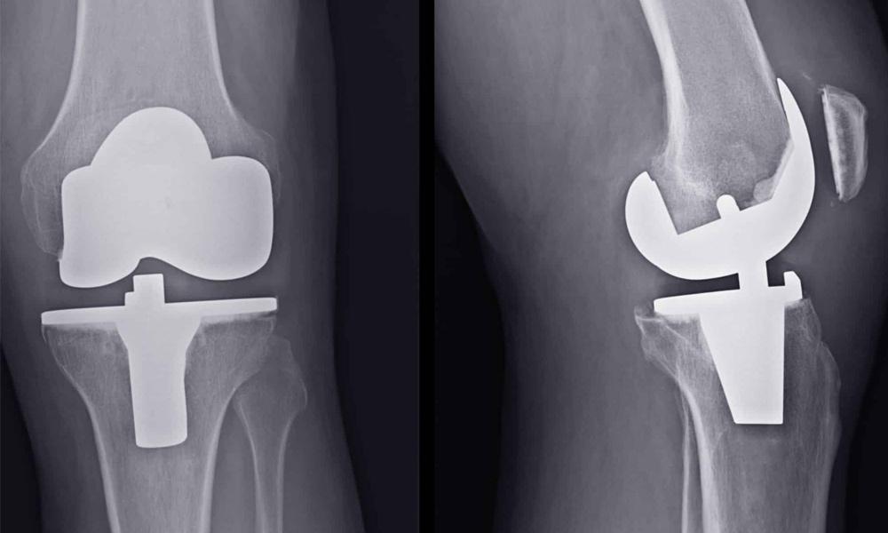 Total-Knee-Arthroplasty-slider1