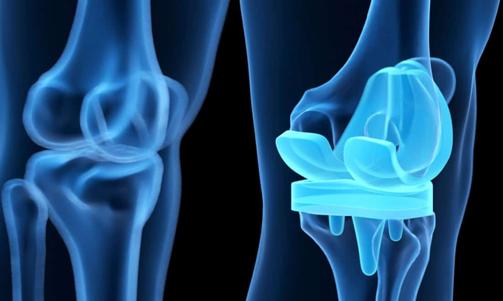 Total-Knee-Arthroplasty-slider2