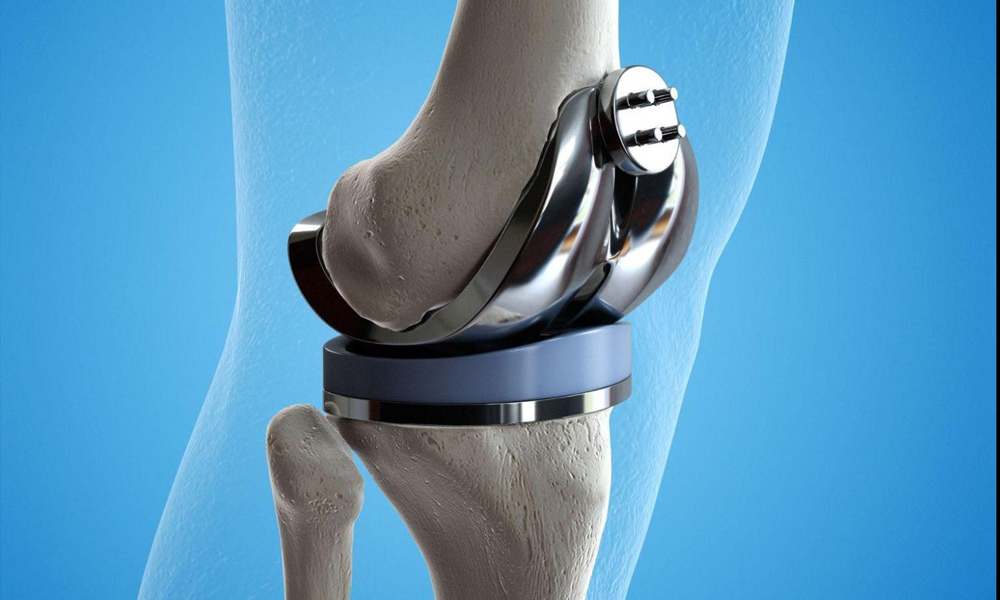 Total-Knee-Arthroplasty-slider3