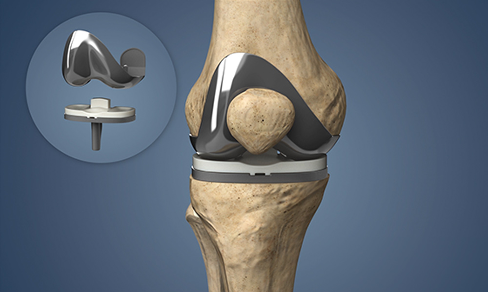 Total-Knee-Arthroplasty-slider4