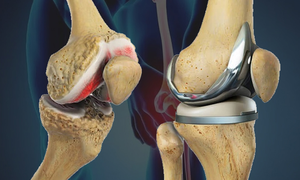 Total-Knee-Arthroplastyslider5